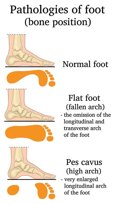 cavus-high-arch-feet-illustration